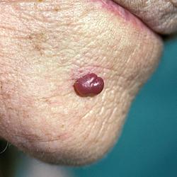 Example of skinLumpsAndBumps